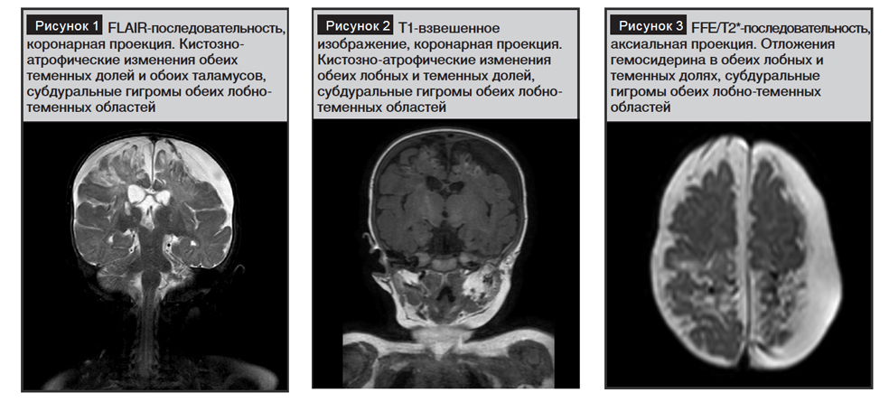 Клинический случай раннего органического поражения головного мозга ...